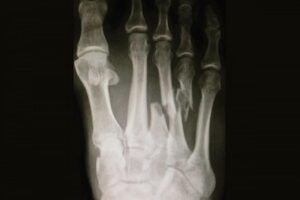 Broken Foot