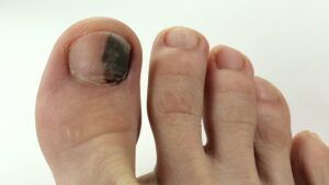 Black Toenails