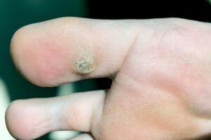 What Is a Plantar Wart?