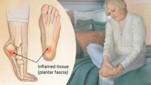 Plantar Fasciitis Heel Pain