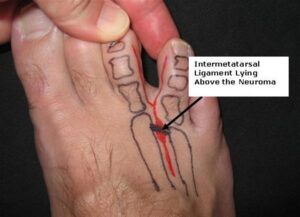 What is a Neuroma?