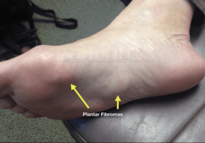 Plantar Fibroma