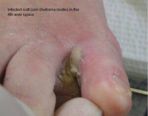Heloma Molle