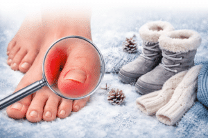 Why Ingrown Toenails Are More Common During Winter