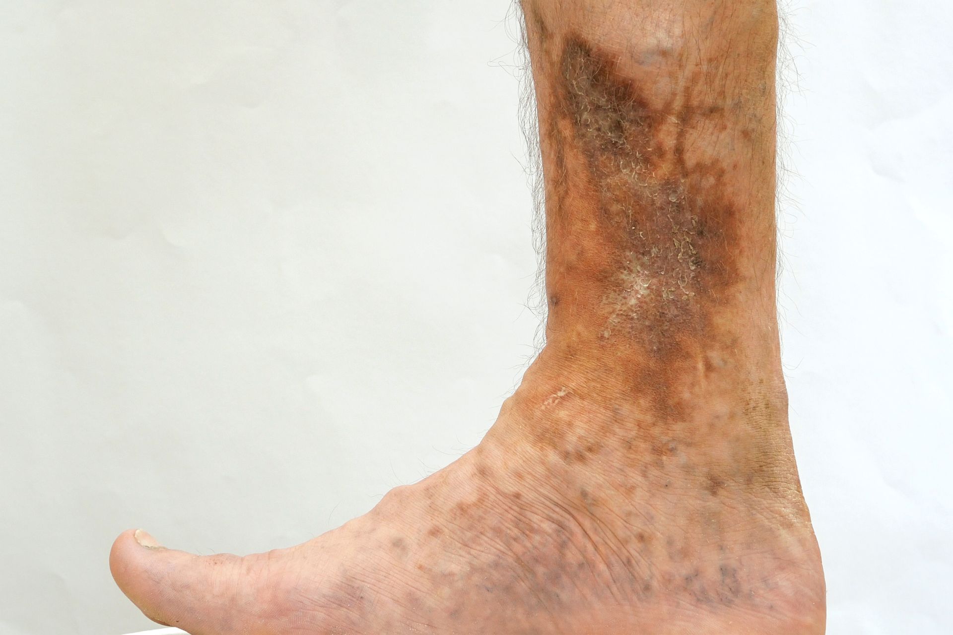 Venous Ulcers